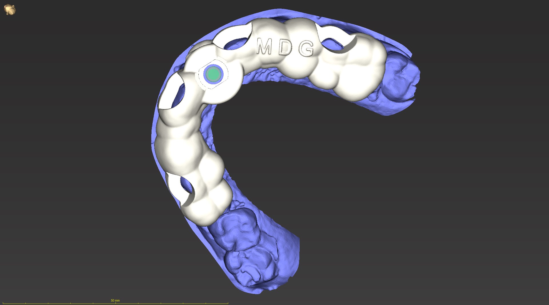 Överkäke - direktinstallation | My Dental Guide