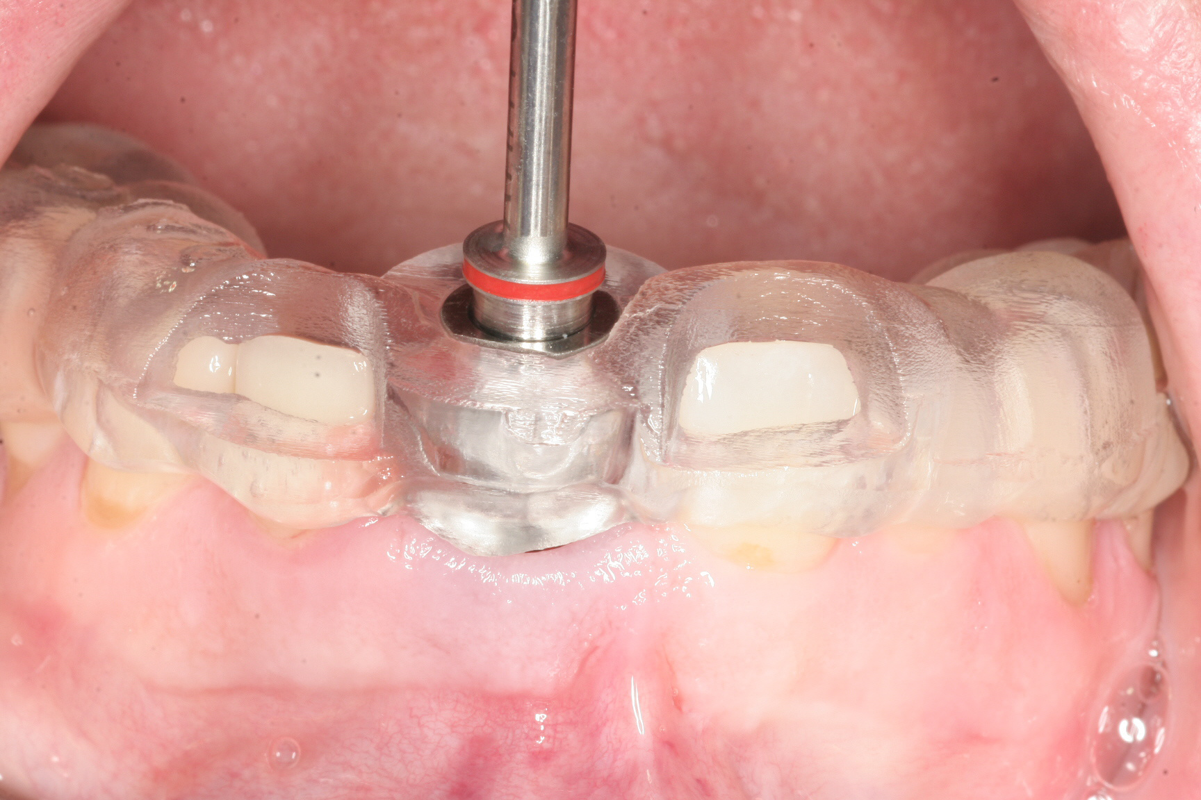 Överkäke - direktinstallation | My Dental Guide